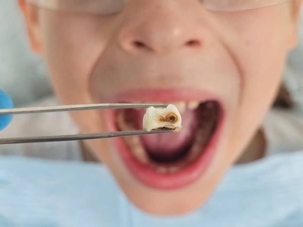 Best Emergency Dentist for Lost Fillings or Crowns in Quantico Base, VA